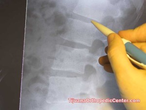 Spinal Fusion in Tijuana - Mexico