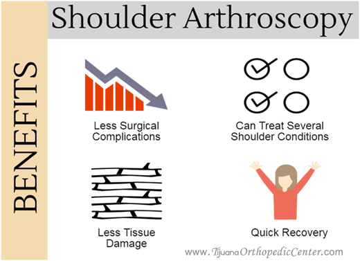 Benefits of Shoulder Arthroscopy