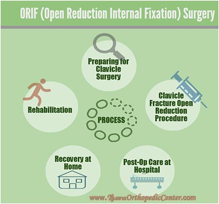 ORIF Procedure - Clavicle Repair