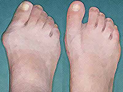 Foot Surgery in Tijuana Mexico